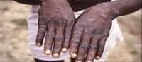 Monkeypox an alarm bell, WHO declared epidemic!!